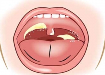 WASPADA!!! Kutim KLB Difteri 