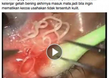 Ngawur, Cacing Mata karena Injak Kecoak