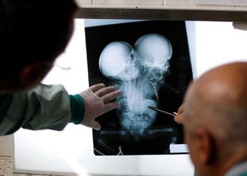 Respon Pemerintah Lambat, Bayi Kembar Siam Tak Tertolong