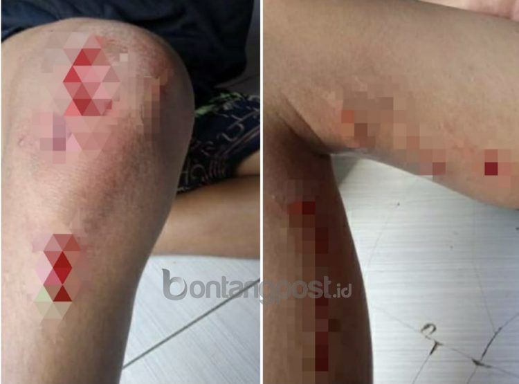 Muhammad Dzaky Husain (16) mendapat sejumlah jahitan usai diserang buaya di Selambai Loktuan.