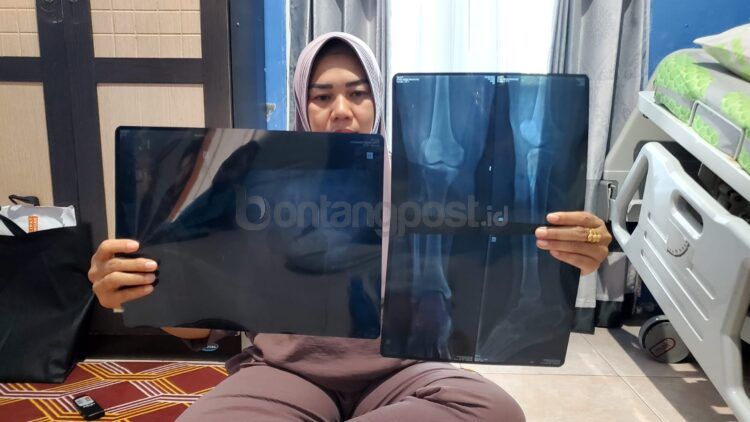 Nur Hasanah memperlihatkan hasil rontgen tiga titik tulang kaki kanan patah yang dialami putrinya, Fitria Risqi Ramadani (Lutfi/bontangpost.id)
