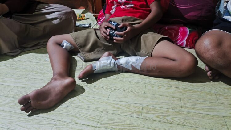 Kondisi anak 11 tahun yang disambar buaya di Tanjung Limau, Bontang.