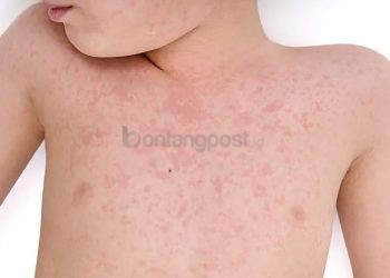 98 Bayi di Bontang Suspek Campak, Dinkes Masih Tunggu Hasil Pemeriksaan Laboratorium